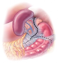 ADRENALECTOMY (2)