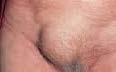 INGUINAL HERNIA REPAIR (3) - 2
