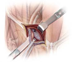 INGUINAL HERNIA REPAIR (3) - 4