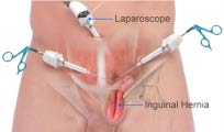 INGUINAL HERNIA REPAIR (3) - 6