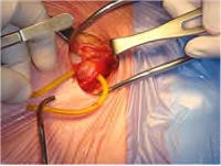INGUINAL HERNIA REPAIR (3) - 7