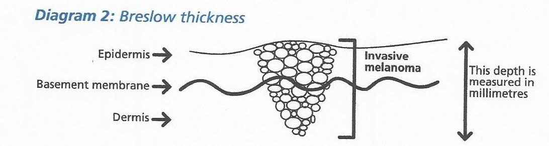 MALIGNANT MELANOMA - 2