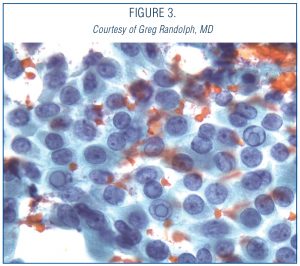 THYROID-SURGERY-3
