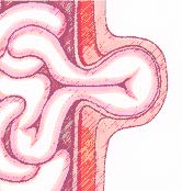 UMBILICAL HERNIA REPAIR (2)